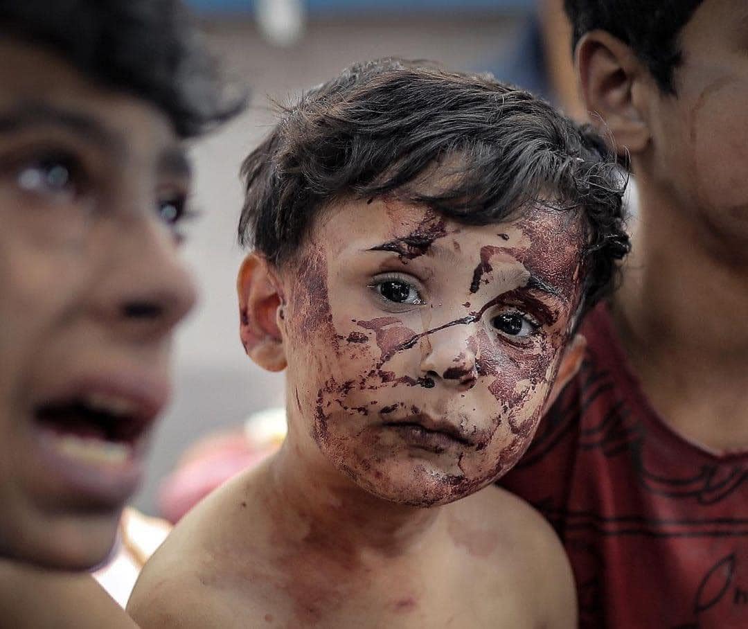  Le bilan des victimes de l’agression israélienne s’alourdit à 6504 et 19 000 blessés 