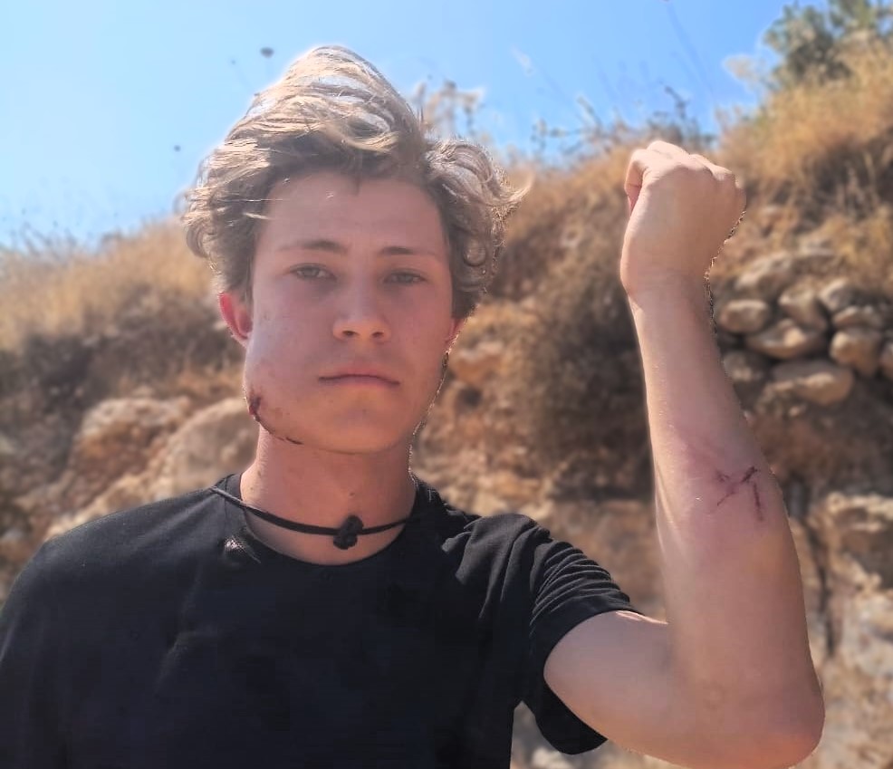 Un Palestinien et un militant étranger blessés dans une attaque coloniale à Naplouse