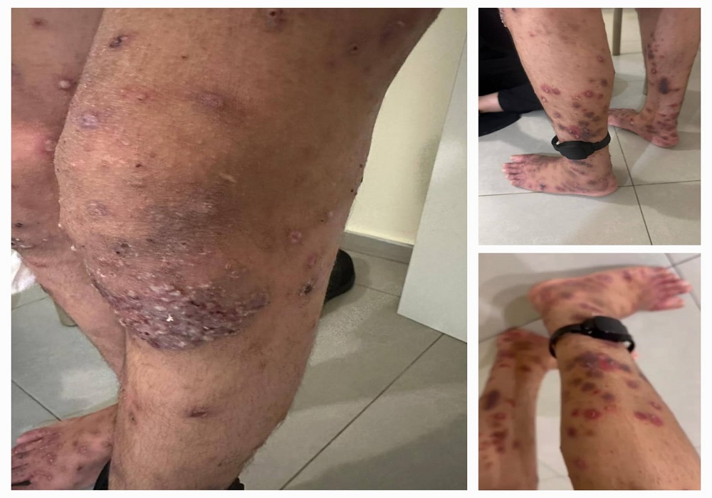 Catastrophe sanitaire à cause de la propagation continue de la « gale » dans les geôles israéliennes