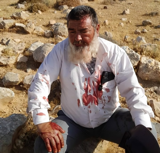Des milices de colons attaquent un père palestinien à Masafer Yatta