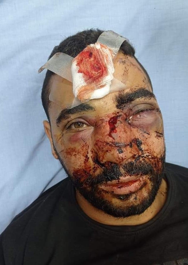 Un jeune palestinien défiguré par les tirs de l’occupation  